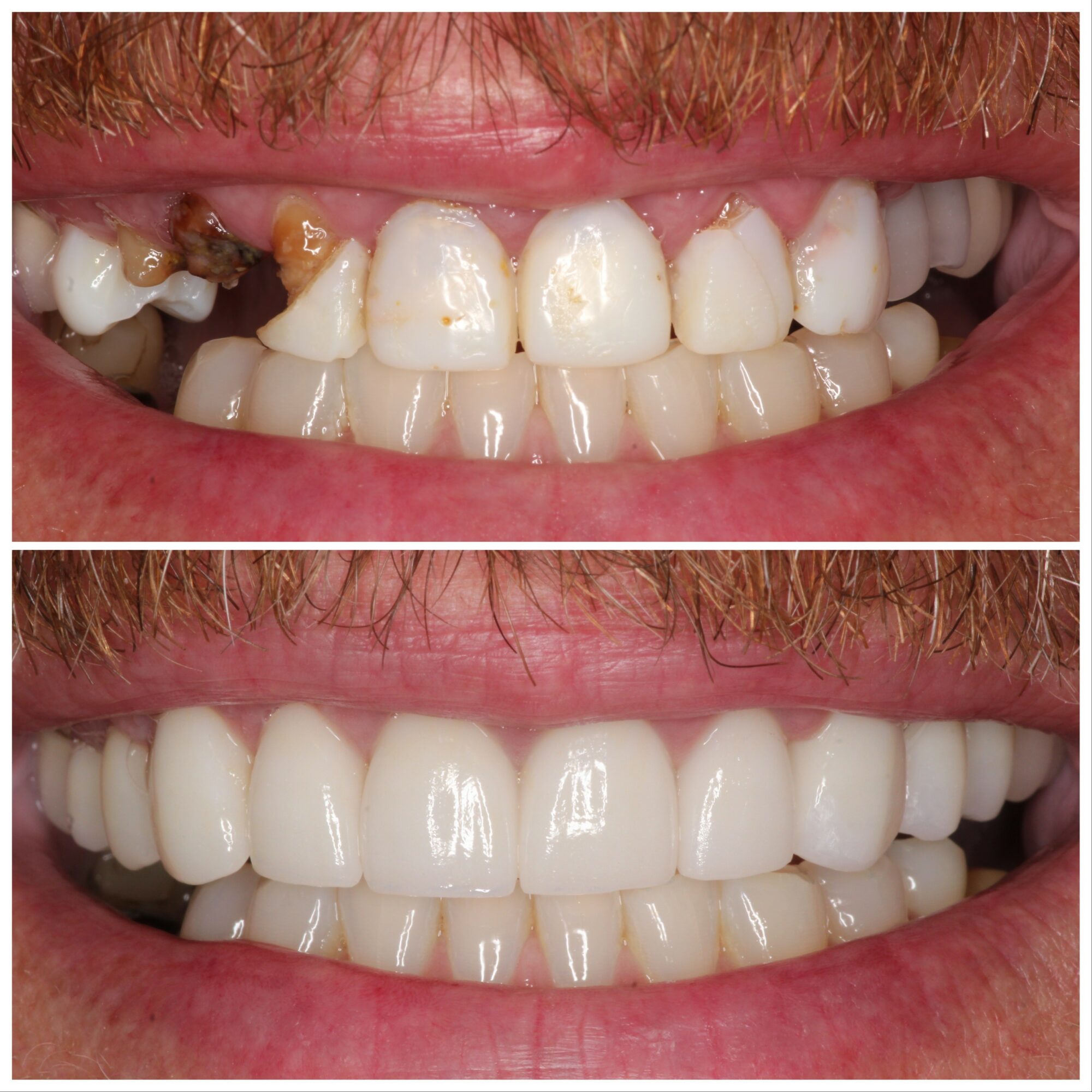 Close-up of a person's teeth before and after dental treatment, showing significant improvement in dental health and appearance.