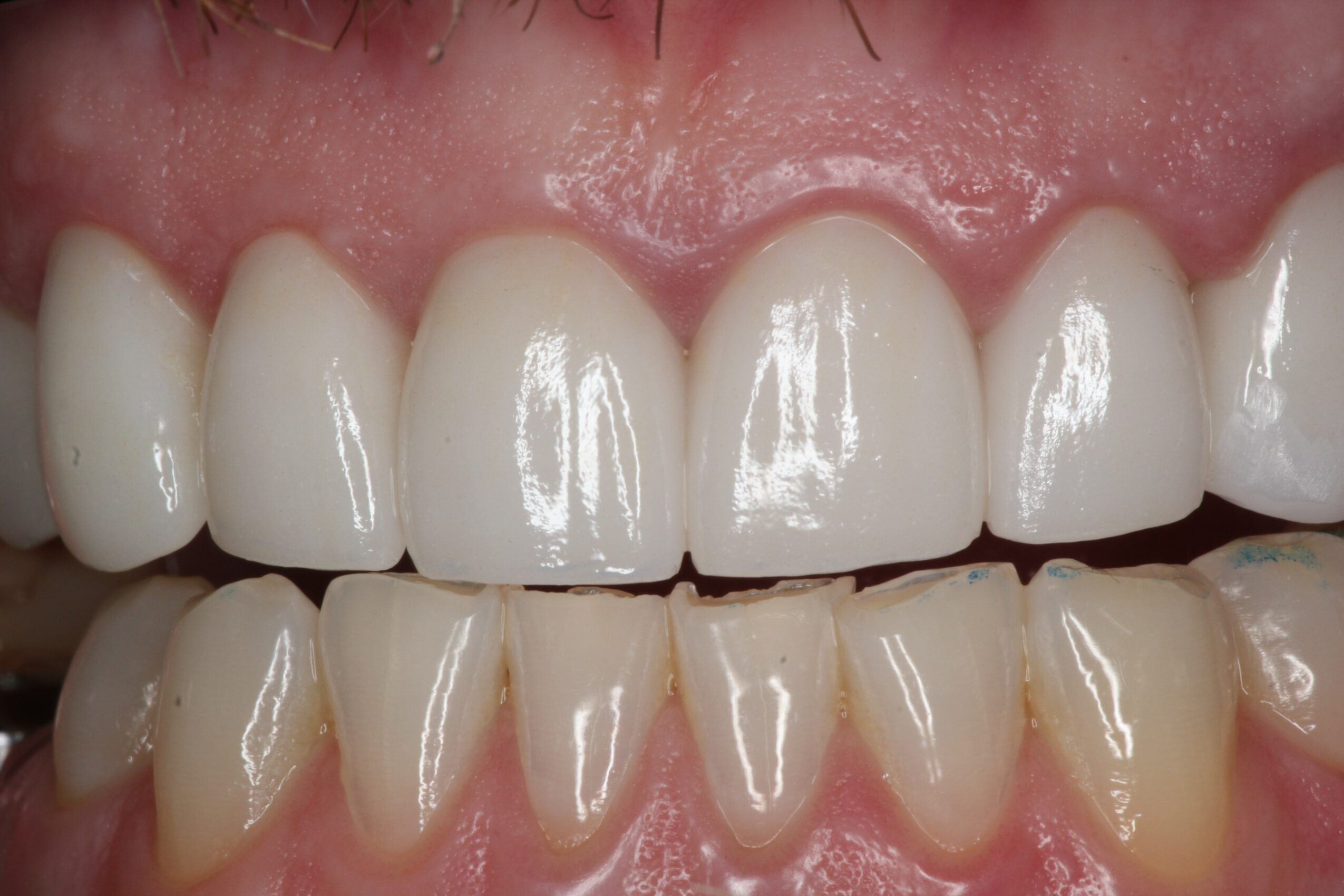 Close-up of upper and lower teeth with healthy gums, showing a natural smile.