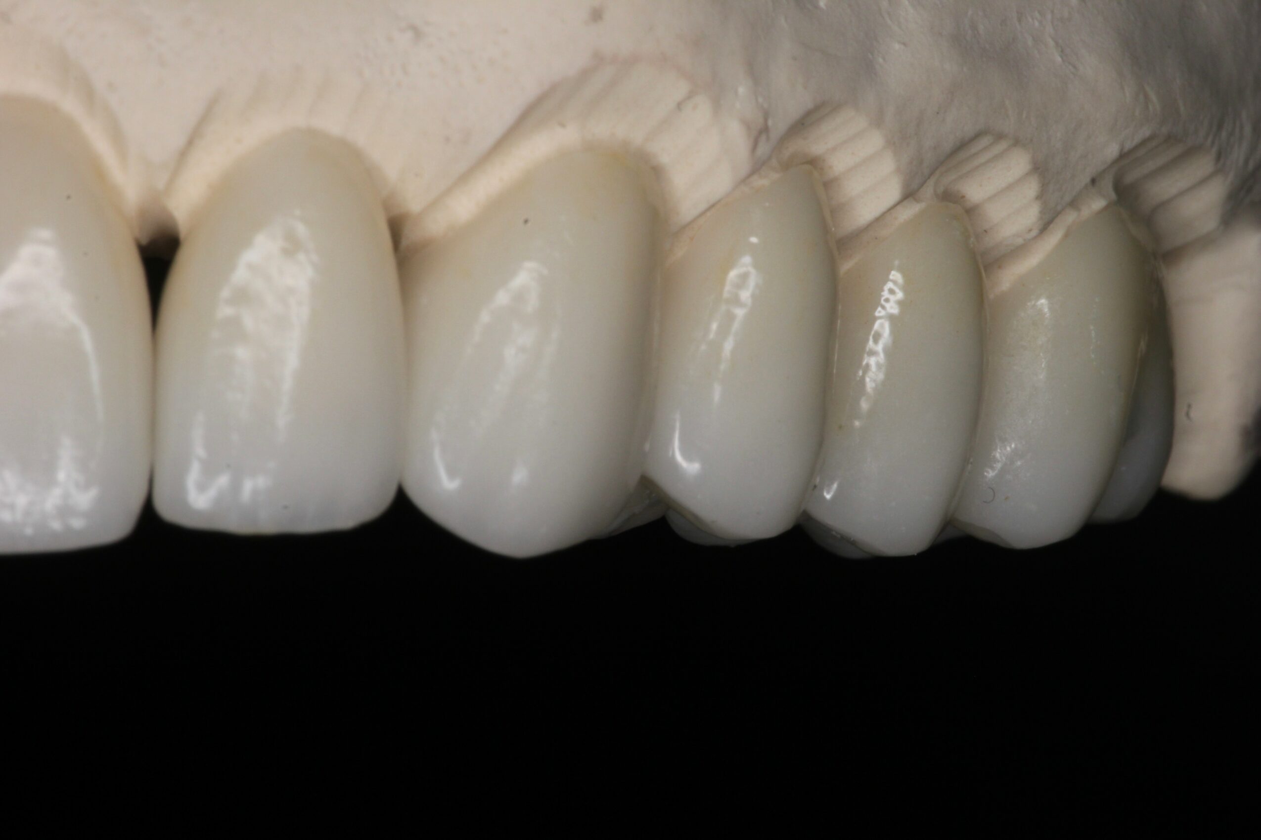 Close-up of a row of white dental crowns or veneers on teeth, viewed from the side.