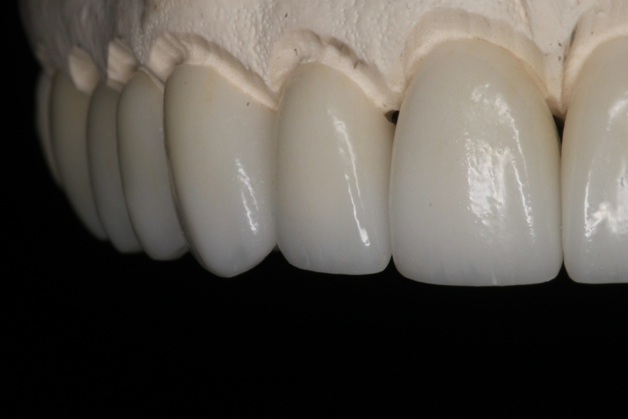 Close-up of a dental model showing upper front teeth with dental crowns or veneers, against a black background.