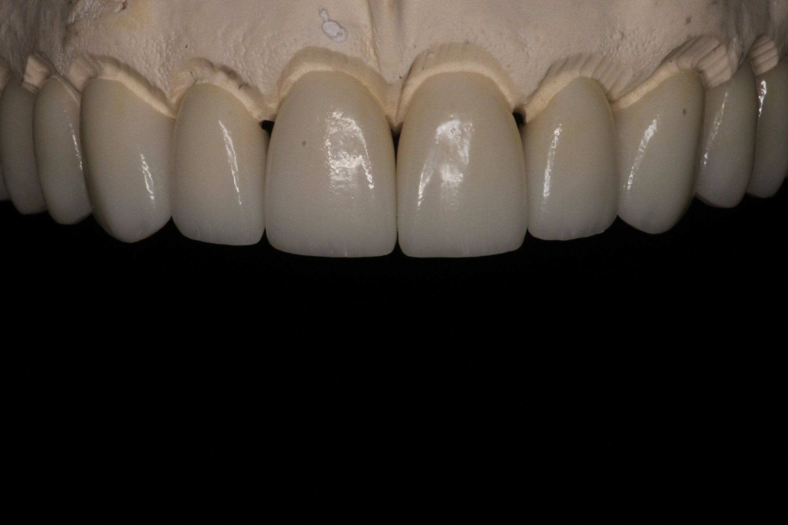 Close-up of upper teeth with dental crowns or veneers, showing a uniform, white appearance.