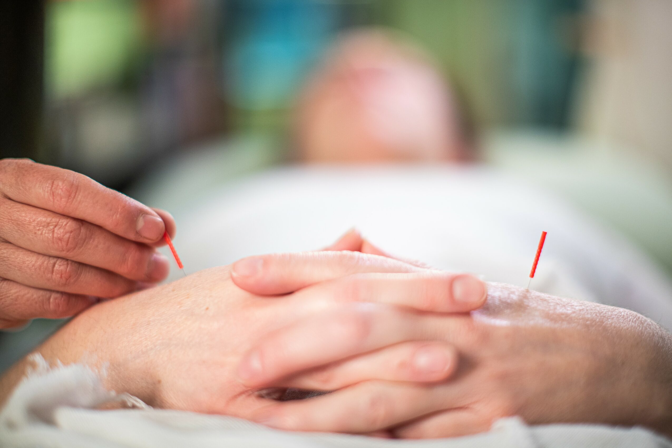 Person receiving acupuncture treatment with needles inserted into their hand, lying on a bed, blurred background.