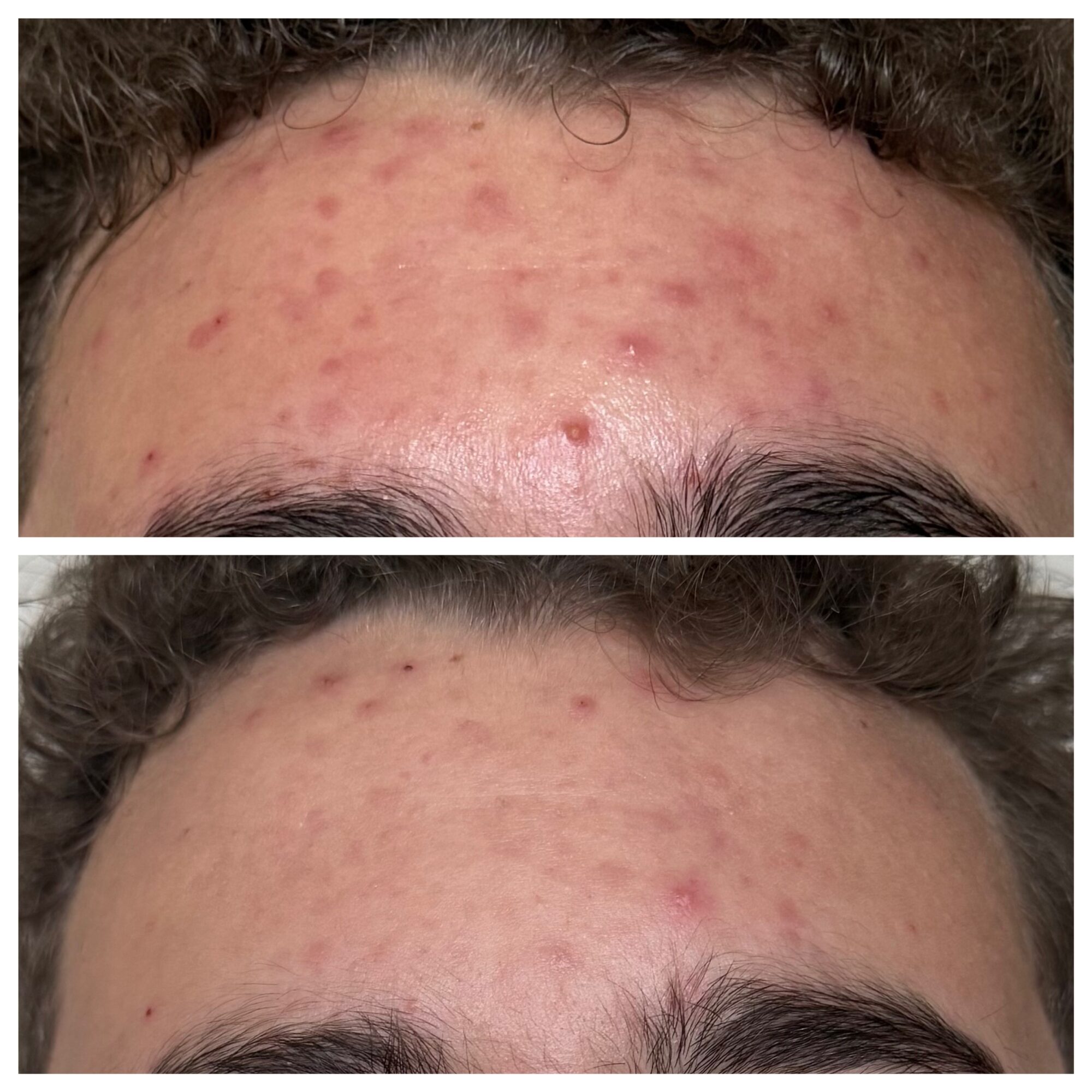 Two close-up views of a forehead with scattered red blemishes, shown one above the other.