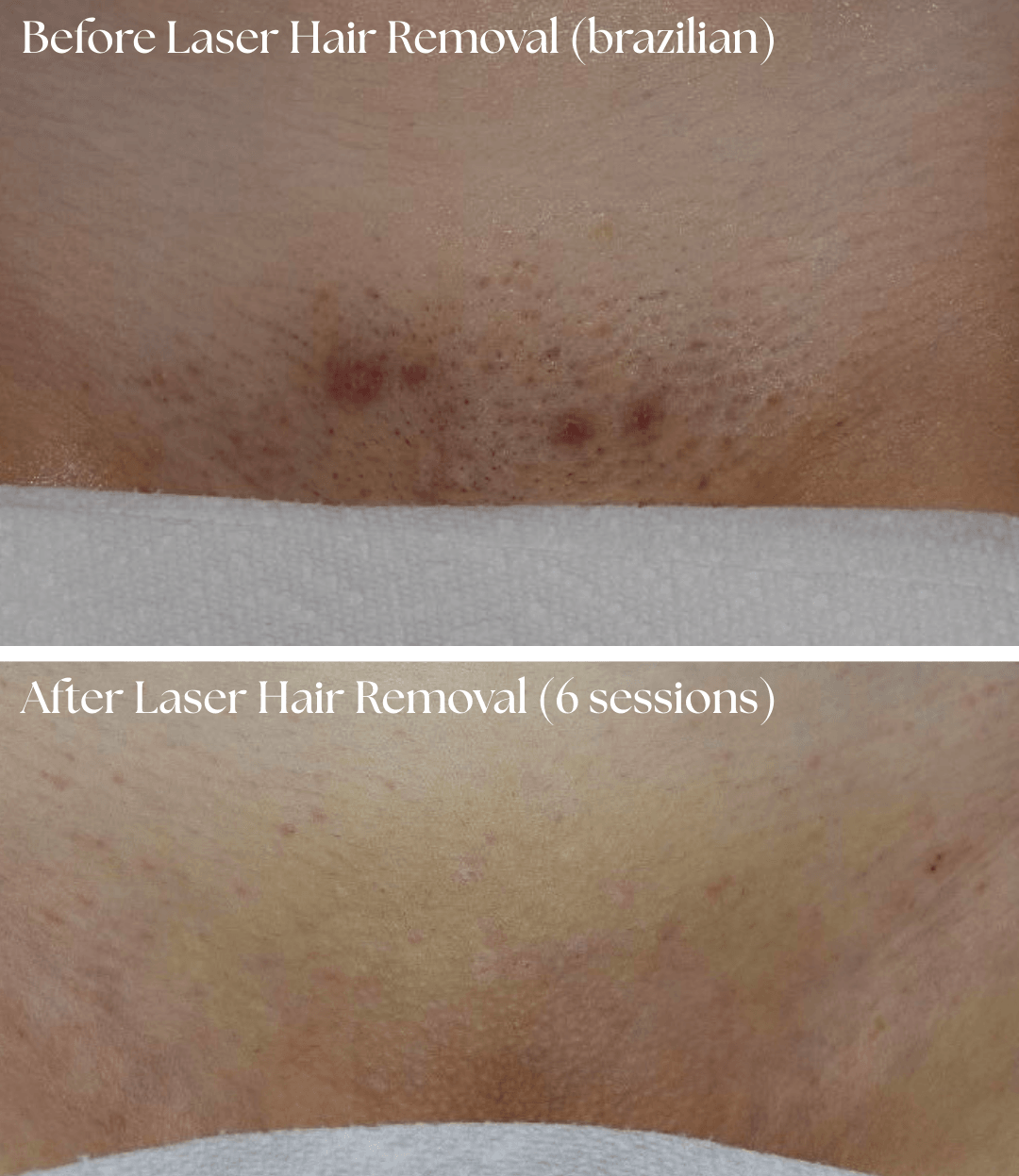 Two close-up skin photos labeled before and after laser hair removal, showing fewer visible spots in the lower image.