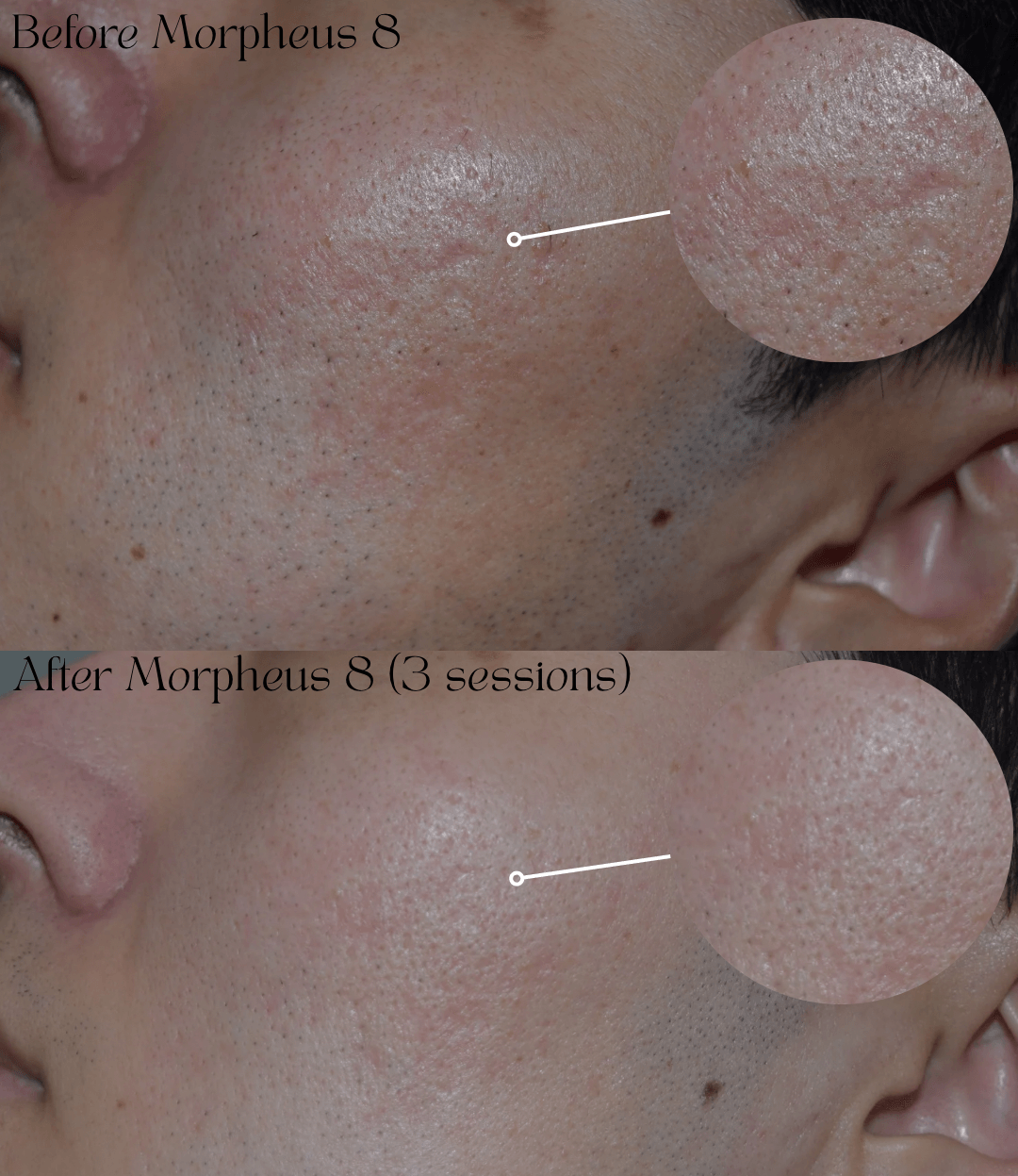 Two close-up views of a person's cheek labeled before and after Morpheus 8 treatment, with enlarged skin details.